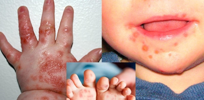 Số ca mắc tay chân miệng tăng 4 lần, Bộ Y tế đề nghị tăng cường phòng chống